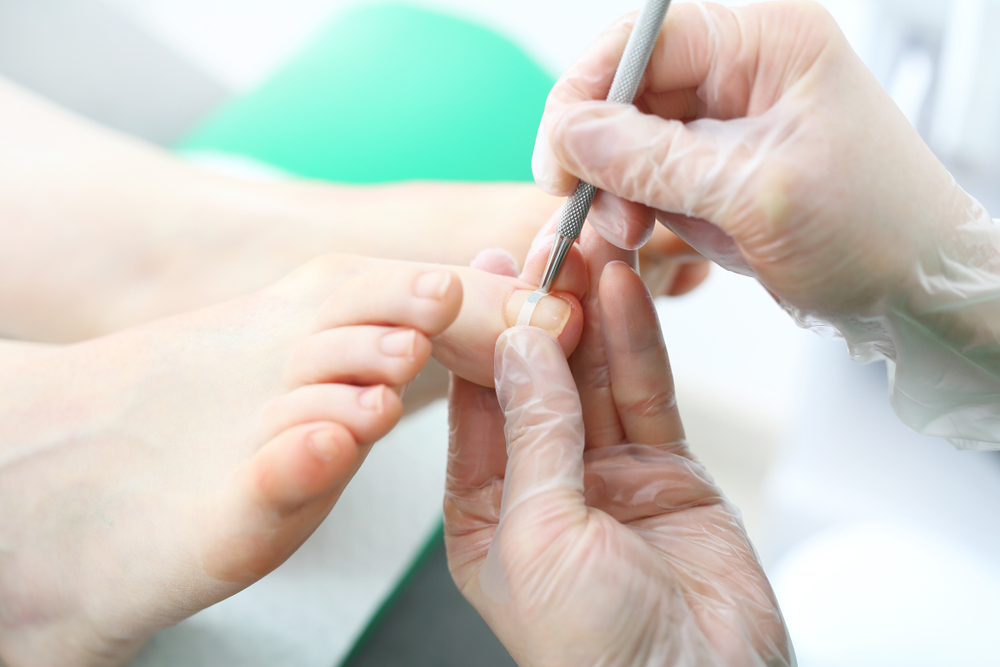 Podology,Clasp.,The,Surgeon,Puts,A,Clamp,On,An,Ingrown Fußpflege Waldenburg - Spangentechnik